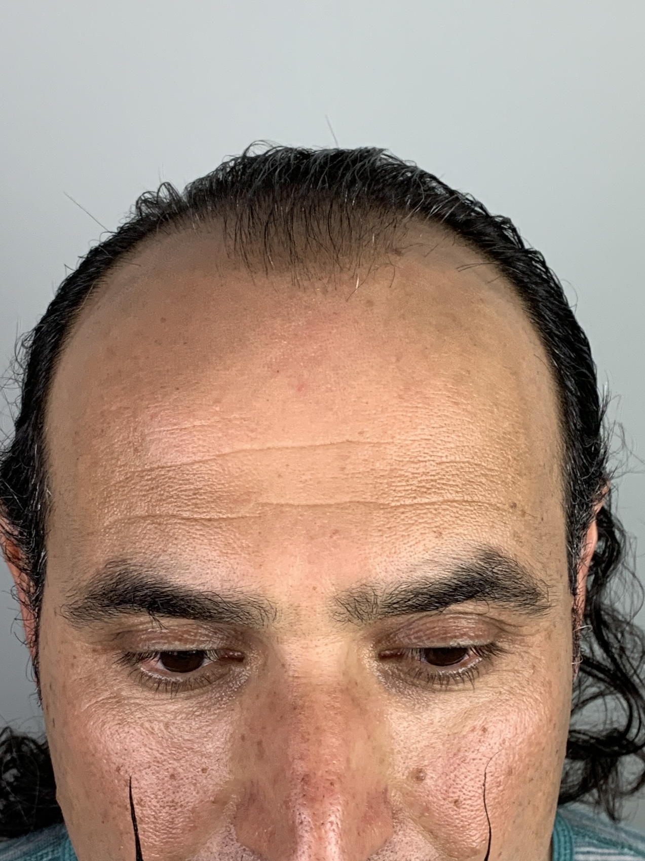 Before-Haartransplantation