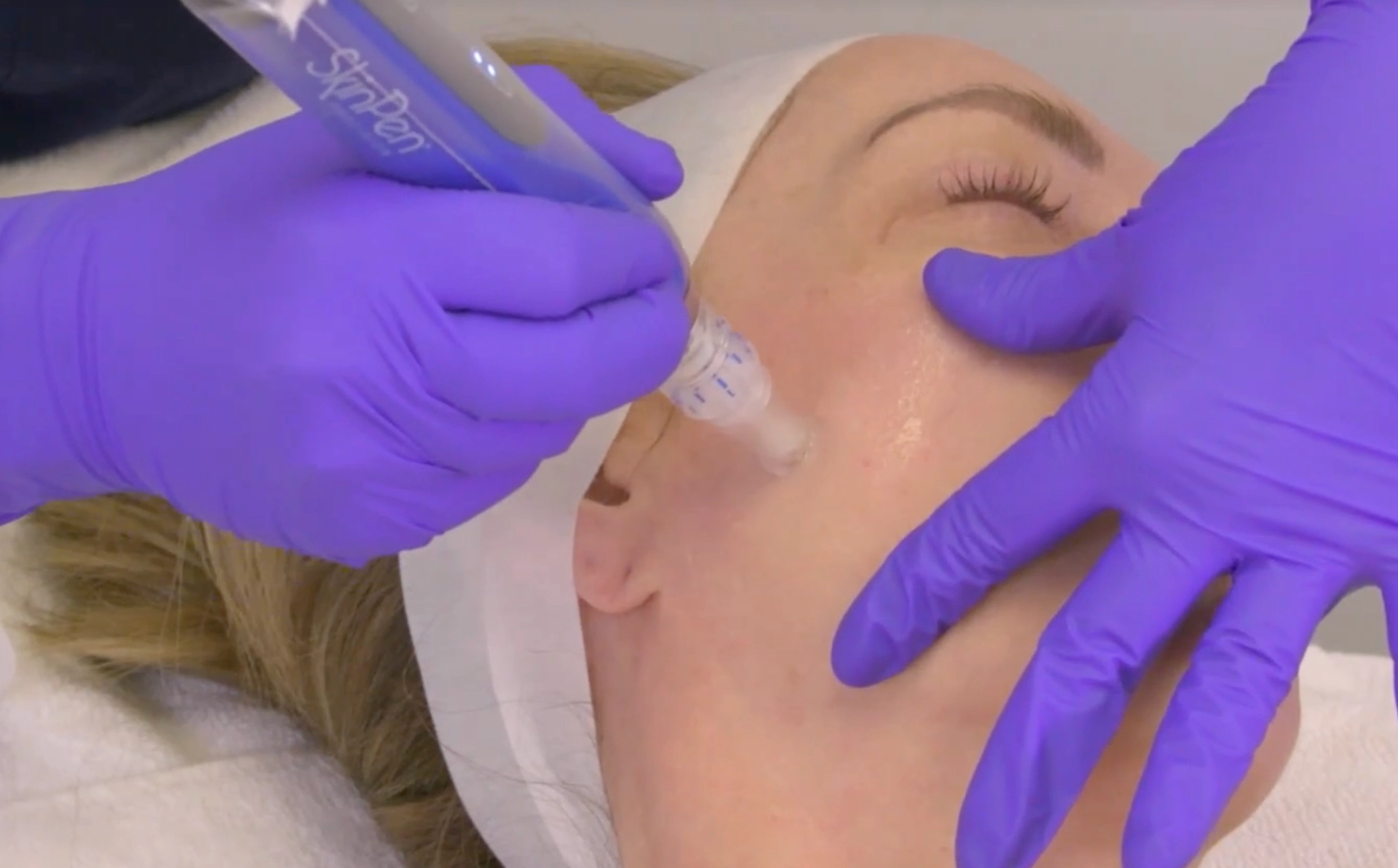 SkinPen Schulung